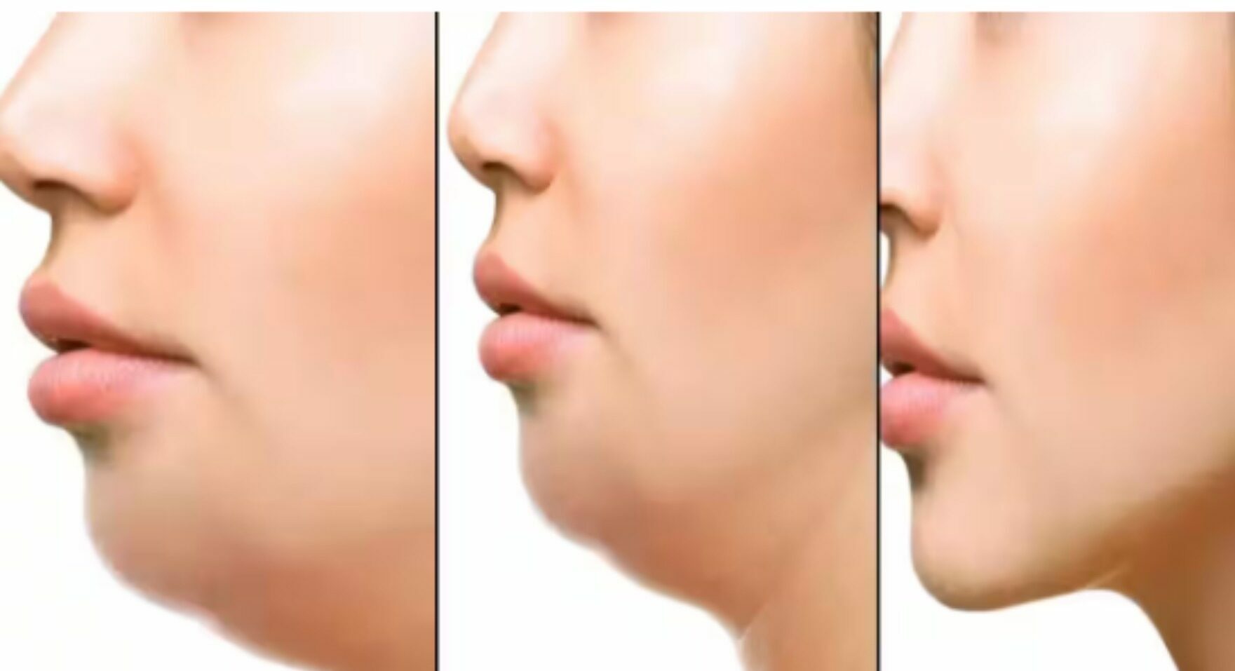 face yoga before and after treatment for double chin